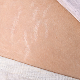 close-up of skin with visible stretch marks on the belly area showcasing skin changes and beauty in ten ways