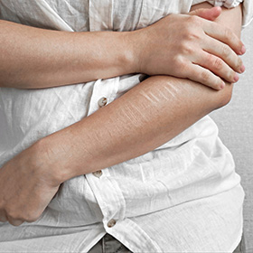 person with light stretch marks on arm wearing white shirt with arms crossed showing 13 signs of skin change