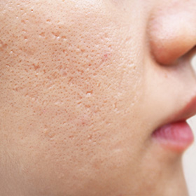 close-up of a person's cheek showing skin texture and pores related to skin care treatments for improving texture and addressing concerns like acne and scars with solutions for a refined appearance 11 tips for healthy skin