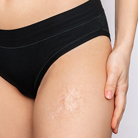 woman in black underwear touching thigh with skin discoloration and texture changes related to stretch marks and skin health including 14 home remedy tips