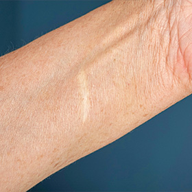 close-up of a forearm with visible skin texture showing a scar or mark related to skin health and care for aging skin 8 factors for skin wellness