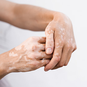 hands with vitiligo showcasing skin condition and diverse beauty 4 skin awareness